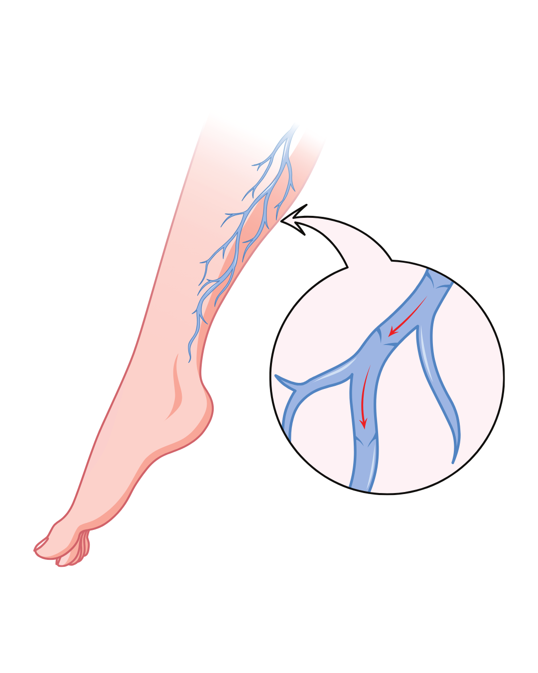 PREVENCIÓN TROMBOSIS VENOSA